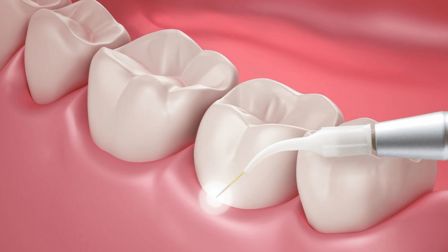 Laser Dentistry, Laser Deep Cleaning & Canker Sore Treatment